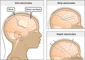 intracranial